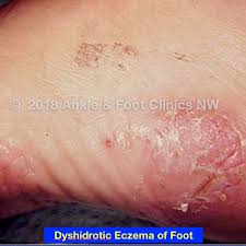 Image result for dyshidrosis