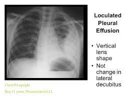 Computed tomography (ct scan) can detect effusions not apparent on plain radiography, distinguish between pleural fluid and pleural thickening. Pleural Effusion In Major Fissure Chest Pa Upright Pneumonia In Rul Mass Like Lesion In Right Lower Chest Ppt Download