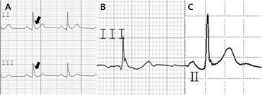Image result for Early Repolarization