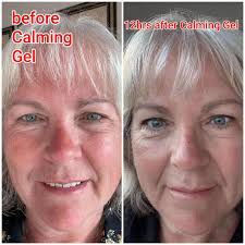 After Sun or Skin Soothe. Which one is more effective