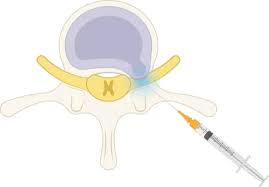 Image result for Cangrelor