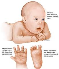 The genetic basis of down syndrome. Down Syndrome Or Trisomy 21 Therapies For Kids