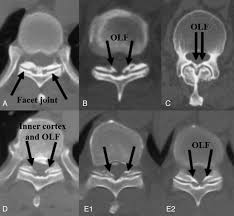 The ligamenta flava (singular, ligamentum flavum, latin for yellow ligament) are a series of ligaments that connect the ventral parts of the laminae of adjacent vertebrae. Dural Ossification Associated With Ossification Of Ligamentum Flavum In The Thoracic Spine A Retrospective Analysis Bmj Open