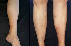 SciELO Brasil - Oxandrolona no tratamento da lipodermatoesclerose: relato  de caso Oxandrolona no tratamento da lipodermatoesclerose: relato de caso