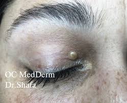 Image result for milium cyst on eyelid