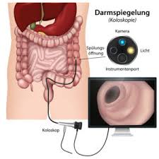 Koloskopie Gastroenterologie Hagen