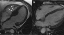In der regel ist es das klinische bild, das den verdacht auf eine herzmuskelentzündung lenkt. Plotzlicher Herztod Bei Sportlern Radiologen Erkennen Warnsignale Drg De