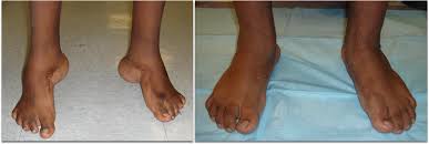 Image result for Clubfoot