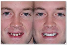 Before and after dentures implants. 21 Dental Implant Before And After Photos