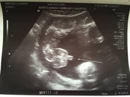 Huge collection, amazing choice, 100+ million high quality, affordable rf and rm images. 20 Week Ultrasound Said Girl But April 2017 Babies Forums What To Expect