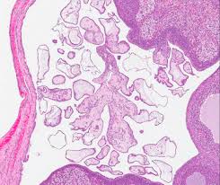 Mesothelioma, also known as malignant mesothelioma, is an aggressive malignant tumor of the mesothelium. Mesothelial Hyperplasia An Overview Sciencedirect Topics