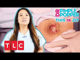 A must for every pimple lover! Doktor Pickel Zyste Kochen Knallen Volles Video