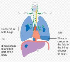 This growth can spread beyond the lung by the process of metastasis into nearby tissue or other parts of the body. Symptoms Of End Stage Lung Cancer In Dogs Dog Discoveries