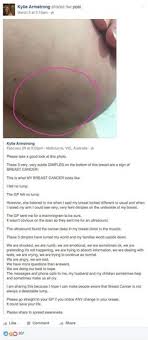 This is what my breast cancer looks like, she wrote on facebook. Fibrocystic Breasts