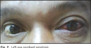 Pdf Orbital Compartment Syndrome In Idiopathic Orbital Inflammatory Disease A Case Report Semantic Scholar