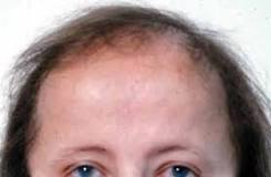 Image result for icd 10 code for androgenic alopecia