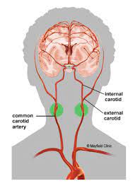 They divide in the neck to form the external and internal carotid arteries. Carotid Artery Stenosis Hope For Hearts Australia