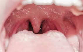 Filter düğmesini seçin ve ardından tür kategorisinin altında küçük resim'i seçin. Damak Yarigi Ameliyatinda Kucuk Dil Onarilir Mi Dudak Damak Yariklari