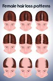 Helps strengthen hair and promote growth. Ann Arbor Mi Female Hair Restoration Hair Loss Treatment For Women