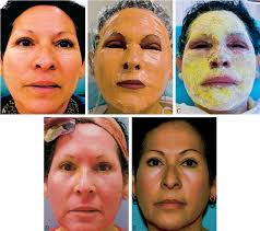 A) Preoperative Latina patient, age ??, SPT IV, with wrinkles. (B)...