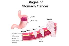 Most children and adults with stomach cancer have no early symptoms or signs until the cancer has advanced. Stomach Gastric Cancer Facts Symptoms Diagnosis Treatments
