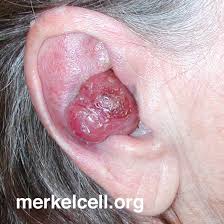 Image result for Merkel Cell Carcinoma