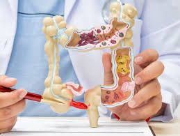 Image result for Appendicitis