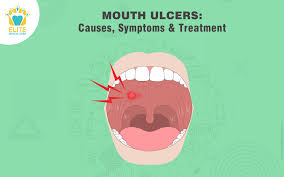 Image result for Canker sores symptoms roof of the mouth