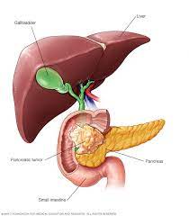 Pancreatic cancer begins in the tissues of your pancreas — an organ in your abdomen that lies behind the lower part of your stomach. Pancreatic Cancer Symptoms And Causes Mayo Clinic