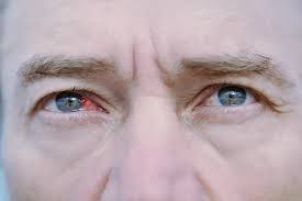 Image result for Allergic Conjunctivitis