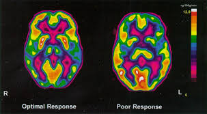 Image result for Pallidotomy