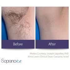 laser hair removal coquitlam cal