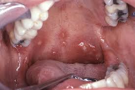 Image result for Hand foot and mouth disease HFMD roof of mouth