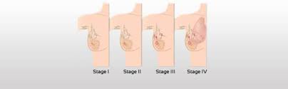 Ibc can best be described as. The Silent Killer Inflammatory Breast Cancer Pictures And Early Detection Youmemindbody