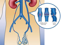 Image result for Varicocele