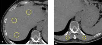 Virtual Unenhanced Imaging Of The Liver Derived From 160 Mm Rapid Switching Dual Energy Ct Rsdect Comparison Of The Accuracy Of Attenuation Values And Solid Liver Lesion Conspicuity With Native Unenhanced Images European Journal