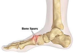 When most people hear the word spur, it's hard to imagine anything other than a dusty john wayne sauntering into town, white hat on. Home Remedies For Bone Spur Natural Treatment