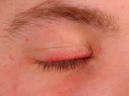 It can be difficult to treat and may require a purpose: Solid Facial Edema In Rosacea Altmeyers Encyclopedia Department Dermatology