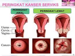Virus ini adalah satu golongan virus. Blog Safeni Feni Tanda Tanda Kanser Serviks Dan Cara Mengurangkan Komplikasinya