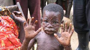 In september 2019, the fda approved an attenuated, live, nonreplicating smallpox and monkeypox vaccine (jynneos) for immunization of adults at high risk for smallpox or monkeypox infection. Monkeypox And Treatment Methods Southernafrican News