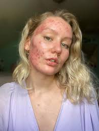 Image result for acne face