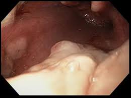 Herpesvirus (hsv) esophagitis is seen predominantly in patients who are immunocompromised. Simultaneous Candida Albicans And Herpes Simplex Virus Type 2 Esophagitis In A Renal Transplant Recipient Bmj Case Reports