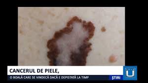 Cancerul de colon si cancerul colorectal (care combina cancerul de colon si cancerul de rect) sunt afectiuni maligne ce apar la nivelul intestinului gros, ultimul segment al tubului digestiv. Cancerul De Piele Se Vindeca Tot Ce Trebuie Sa Stii Despre Cancerul De Piele