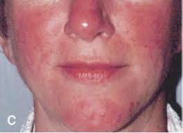 The efficacy of topical metronidazole in the treatment of ocular rosacea. Rosacea Possibile Marker Di Altre Patologie Anche Diabete Diabete Com