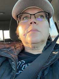 Has anyone had a SMAS neck lift? Here is my before, top left, and now three  weeks out. It's going right back where it was. Doc says skin will tighten  over the