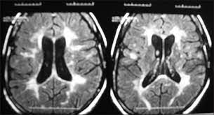 Multiple Sclerosis Or Neurological Manifestations Of Celiac Disease Shaygannejad V Ghasemi M Mirmohamadsadeghi M Adv Biomed Res