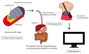 Image result for Colonoscopy in GI Bleeding