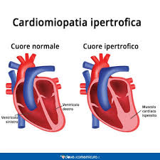 Ces douleurs peuvent survenir de façon subite, aiguë et d'intensité importante. Dolore Al Petto Sinistro O Destro Cause Sintomi E Rimedi