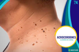 Dermanorte Elimina Esos Molestos Lunares De Carne Facebook