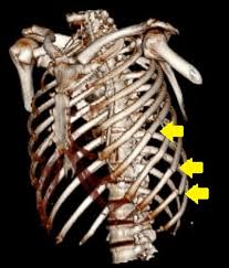 Image result for Chest Trauma